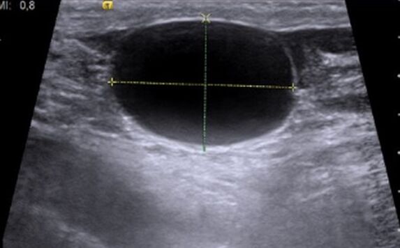 Cystonette helped with chronic cystitis, my bladder is normal